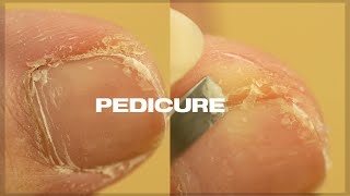 Satisfying PEDICURE TRANSFORMATION at home  Cuticle amp Callus Removal [upl. by Ennovahs]