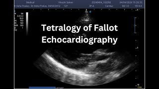 Tetralogy of Fallot  Point of Care ECHO  Short Video [upl. by Oidivo]