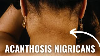 How To Get Rid of Acanthosis Nigricans  Dark Armpits Groin and Neck [upl. by Annoit]