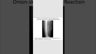 Onion skin periosteal reactionrevision neetpg inicet [upl. by Suraved]