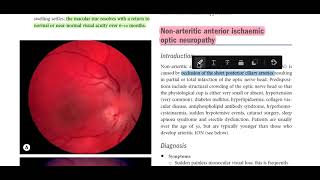 Kanski Clinical Ophthalmology Made Easy  neuro ophthalmology 6 ischemic optic neuropathy [upl. by Anavoj]