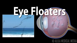 Eye Floaters and Flashes Animation [upl. by Bibi]