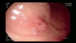 early gastric cancer [upl. by Parthen]