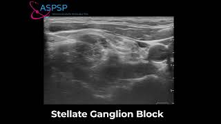 Stellate Ganglion Block for COVID Tongue [upl. by Arais735]