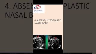 Absent or hypoplastic nasal bone an antenatal scan nasalbone hypoplasticnasalbone [upl. by Torrence]