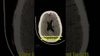 Lacunar Infarct in left gangliocapsular region radiology shortvideo ct brain [upl. by Hertz]