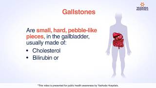 Gallstones  Cholelithiasis Symptoms Causes Diagnosis and Treatment [upl. by Liuka659]