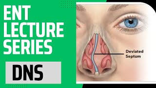 Deviated Nasal Septum  DNS  ENT Lecture Series For Medical Students  Lecture 1 [upl. by Tisbee]