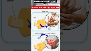 Guillain Barre Syndrome gbs  guillain barre syndrome treatment homeopathy  guillainbarresyndrome [upl. by Euphemiah788]