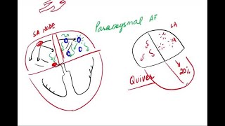 Atrial Fibrillation  Pathophysiology and Clinical [upl. by Obeng920]