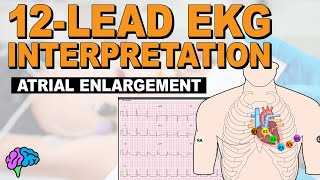 IDENTIFY Atrial Enlargement on 12Lead EKG [upl. by Oakman141]