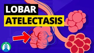 Lobar Atelectasis Medical Definition  Quick Explainer Video [upl. by Edelsten]