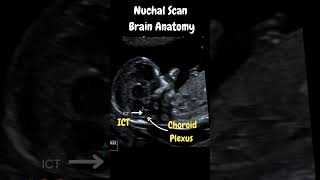 Ultrasound Nuchal Scan Must know Important Brain Anatomy [upl. by Ynoffit]