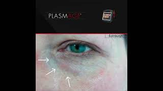 Remove Xanthelasma with Plasmage ®  such a simple and fast operation [upl. by Scharaga]