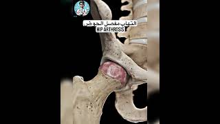 فيديو يوضح التهاب مفصل الحوض hiparthrosis hipreplacement arthritis nursingunlimitedvision [upl. by Grory]