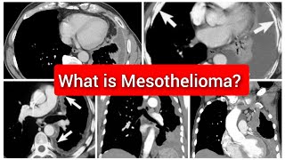 Mesothelioma of Pleura CT Chest [upl. by Nnylarac661]