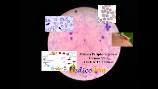 Peripheral Smear  Plasmodium falciparum  Thick and Thin Blood Smear  Giemsa Stain  Malaria [upl. by Nivra]