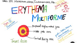 Erythema Multiforme EM causes symptoms treatment  skin disorder [upl. by Chaunce703]