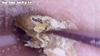 Ear Wax Removal 170 He was tormented by itchy ears every night  Ear Cleaning ASMR [upl. by Rusty]