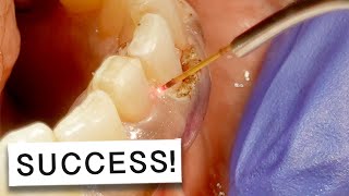 Laser Gum Surgery Success Story INCREDIBLE Outcome 🤩 [upl. by Mercier]