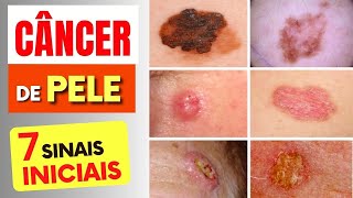 7 SINAIS de Alerta para CÂNCER DE PELE que Todos Deveriam Saber e Dicas IMPORTANTES [upl. by Einnij]