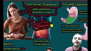 Functional Dyspepsia Upper Abdominal pain Epigastric pain Symptoms causes and treatment [upl. by Airamesor492]