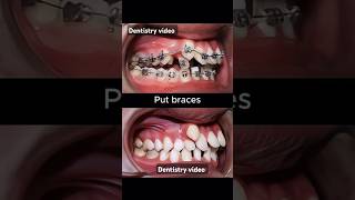 Braces are very crooked teeth braces orthodontist dentistry dentist allaboutbraces [upl. by Kalagher]