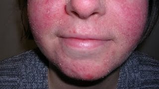 How to Treat Facial Eczema DermTVcom Epi 479 [upl. by Moya]