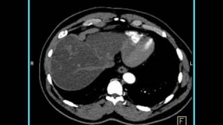 Abdomen Liver CT demonstrates a hemangioma of the liver because of the fatty infiltration1 of 10 [upl. by Ylimme984]