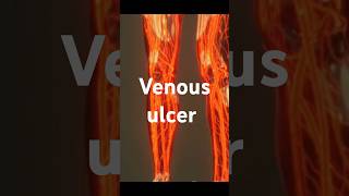 Venous ulcer thrombosismedicine healthtipshealth healthcaresymptoms treatmentvenousulcer [upl. by Aienahs411]