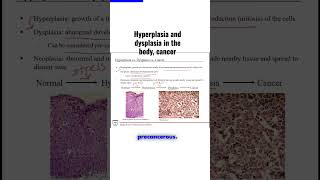 Hyperplasia and dysplasia in the body cancer [upl. by Boni266]