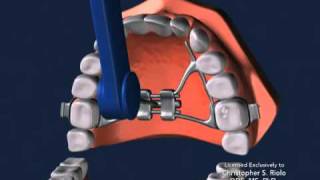 Seattle Orthodontist Dr Christopher Riolo Banded Expander RPE [upl. by Yoc]