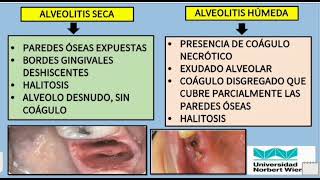 ALVEOLITIS SECA Y HÚMEDA [upl. by Sybilla]