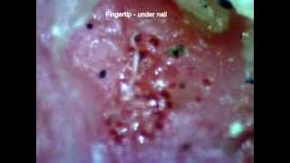 MORGELLONS  Abnormal Nails [upl. by Leia401]