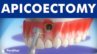 Apicoectomy  Treatment of root canal infection © [upl. by Enaz]