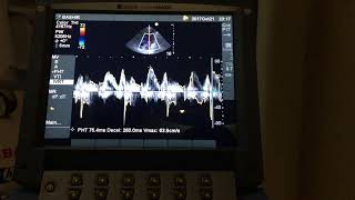 SONOSITE MICRO MAXX PART 3 [upl. by Ingram534]