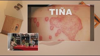 Dermatología Tiña corporis Hongos en la piel [upl. by Yema]