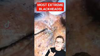 Major BLACKHEAD REMOVAL  Biggest Extractions shorts [upl. by Une]