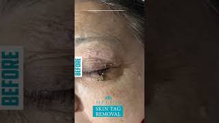 SKIN TAG REMOVAL  SKIN TAG TREATMENT  CAUTERY  BEST SOLUTION FOR SKIN TAG [upl. by Gwendolin]