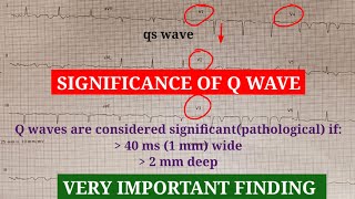 Pathological q wave diagnosis and ECG interpretation [upl. by Vi]