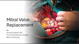 Mitral Valve Replacement Part 1 [upl. by Dimitri]