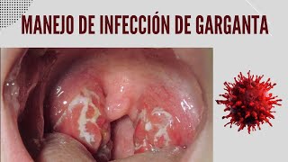 Manejo de la Infección y dolor de garganta [upl. by Natalee234]