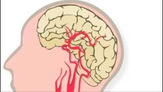 Trombolyse behandeling na een herseninfarct [upl. by Dranoel]