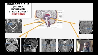 Brain herniation syndromes [upl. by Pul]