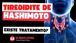 Existe tratamento para tireoidite de Hashimoto [upl. by Jonie]