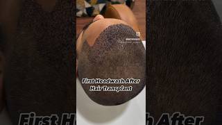 First head wash after hair transplant  Dr Nandini Dadu￼ [upl. by Kinsley67]