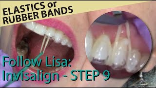 🦷 Follow Lisa Invisalign 9  Gap in tray and placement of elastic bands [upl. by Wes]