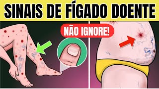 10 SINAIS de PROBLEMA no FÍGADO na PELE  Sintomas de GORDURA NO FÍGADO CIRROSE e HEPATITE [upl. by Ecirahs887]