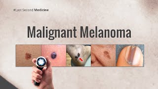 Malignant Melanoma [upl. by Lilac840]