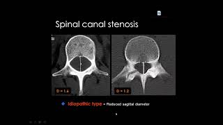 Imaging of spinal degenerative disease Prof Mamdouh Mahfoz radiodiagnosis Cairo University [upl. by Enyak]